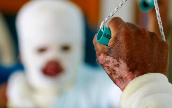  En Santander se registró el primer quemado con pólvora en diciembre